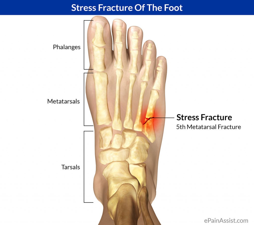 How do you know if you have a bone stress facture? | Sports Physio