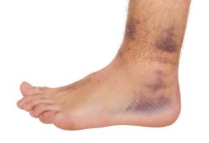 what to do following ankle sprain injury gold coast running