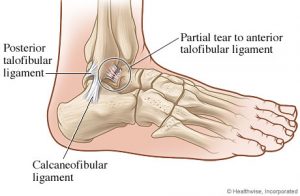 gold coast physio ankle sprain