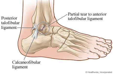 gold coast physio ankle sprain