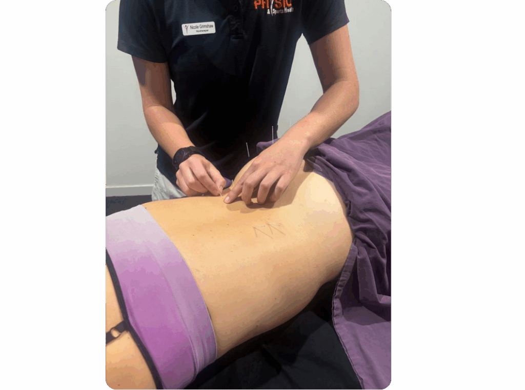 Myotherapist using dry needles